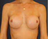 Natural Breast Augmentation 013 - after