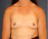 Breast Augmentation 150 - before