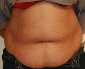 Tummy Tuck Case 28 - before
