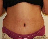 Tummy Tuck Case 28 - after