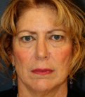 Facelift 104 - before