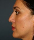 Rhinoplasty 210 - before