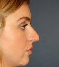 Rhinoplasty 211 - before