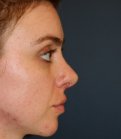 Rhinoplasty 211 - after