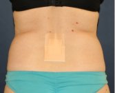 Liposuction Back-Flanks 211 - before