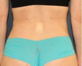 Liposuction Back-Flanks 211 - after