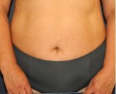 Tummy Tuck 233 - before
