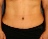 Tummy Tuck 233 - after
