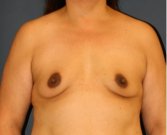 Breast Augmentation 153 - before