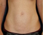 Tummy Tuck 234 - before