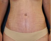 Tummy Tuck 234 - after