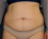 Tummy Tuck 235 - before