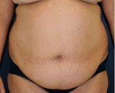 Tummy Tuck 236 - before