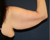 Arm Reduction 210 - before