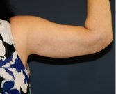 Arm Reduction 210 - after