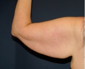 Arm Reduction 211 - before