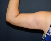 Arm Reduction 211 - after