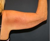 Arm Reduction 212 - before