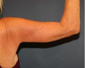 Arm Reduction 212 - after