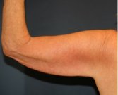 Arm Reduction 213 - before