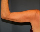 Arm Reduction 213 - after