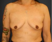 Breast Augmentation Lift 63 - before