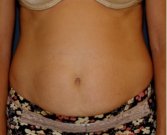 Tummy Tuck 237 - before
