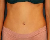 Tummy Tuck 237 - after