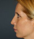 Rhinoplasty 212 - before