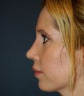 Rhinoplasty 212 - after