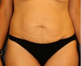 Tummy Tuck 238 - before