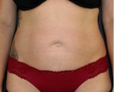 Tummy Tuck 239 - before