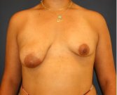 Breast Asymmetry 103 - before