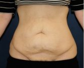 Tummy Tuck 240 - before
