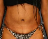 Tummy Tuck 241 - after
