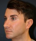 Revision Rhinoplasty 205 - before