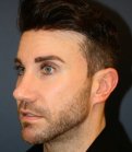 Revision Rhinoplasty 205 - after