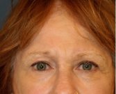 Browlift Case 105 - after