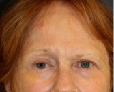 Blepharoplasty 109 - before
