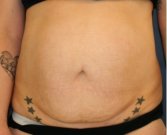Tummy Tuck 242 - before