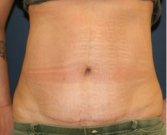Tummy Tuck 242 - after