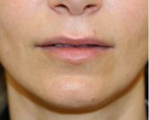 Upper Lip Lift & Lower Lip W-Plasty 211 - before
