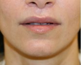 Upper Lip Lift & Lower Lip W-Plasty 211 - after