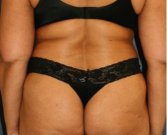Liposuction Back-Flanks 212 - before