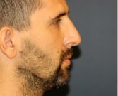 Rhinoplasty 213 - before