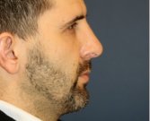 Rhinoplasty 213 - after
