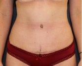 Tummy Tuck 243 - after
