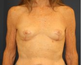 Breast Implant Removal 202 - after