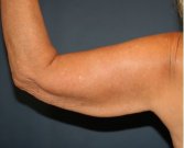 Arm Reduction 214 - before