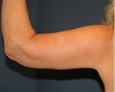 Arm Reduction 214 - after